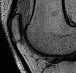 Loose Body Knee MRI PFJ Sagittal